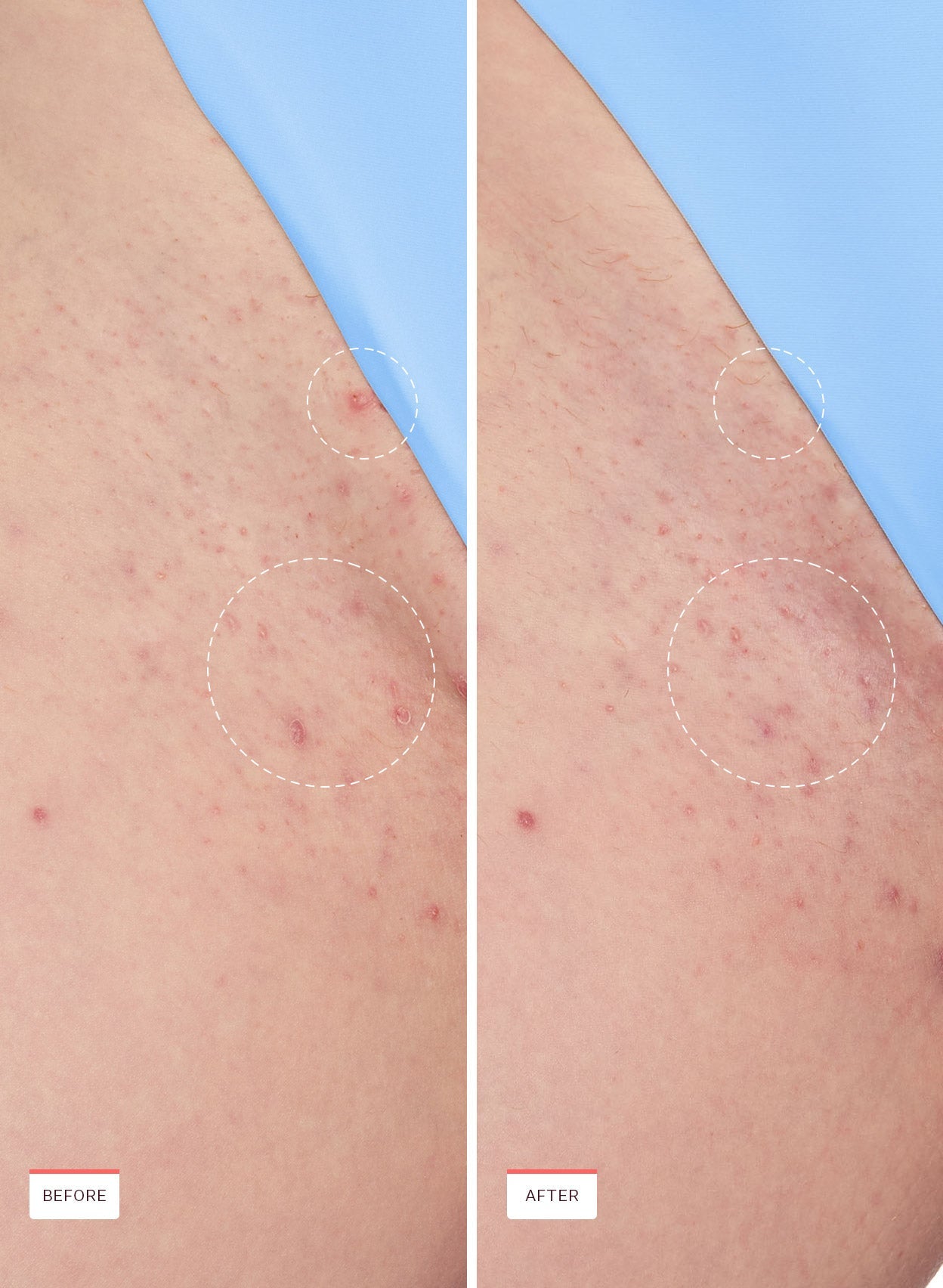 Ingrown Hair Treatment - Peach Slices Smoothing Solution